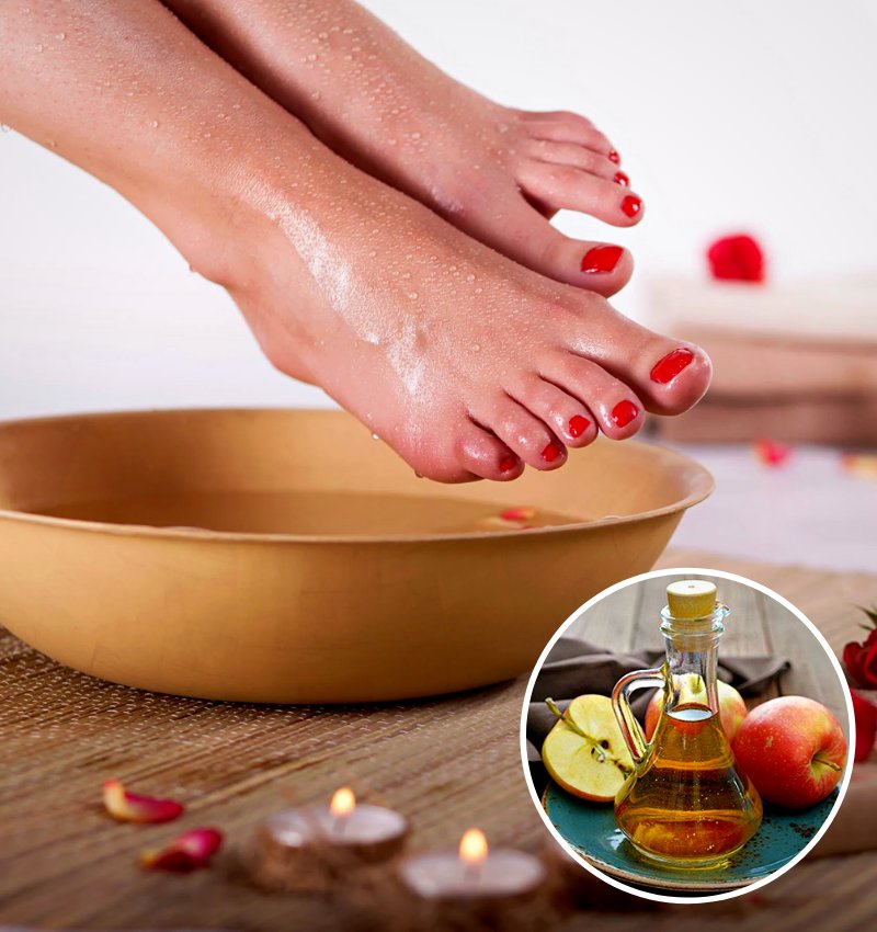 Pies con talones agrietados sumergidos en agua con vinagre de manzana